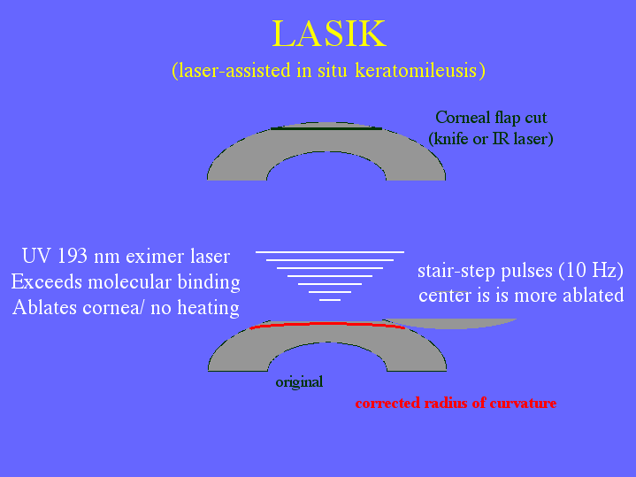 LASIK (laser-assisted In Situ Keratomileusis)