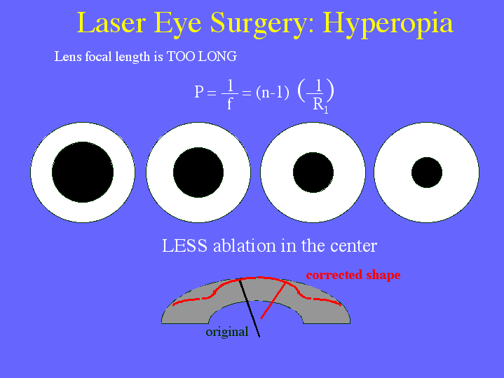 Lasik surgery far sighted